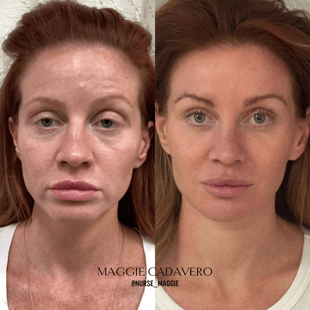 Lip filler injection before and after