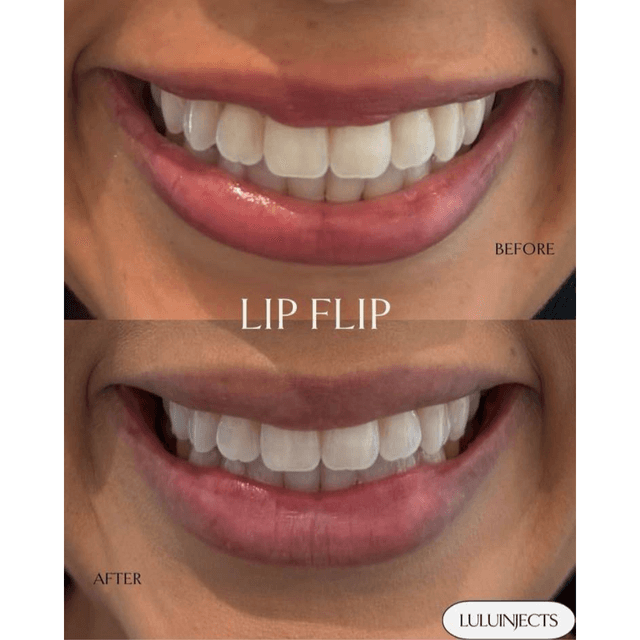 Level Up Your Smile with a Lip Flip 💉 A lip flip subtly relaxes the muscles above the upper lip, creating a fuller-looking pout—no filler required. It’s quick, affordable, and perfect for a natural-looking enhancement that highlights your smile.