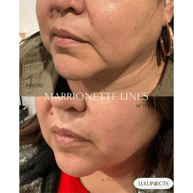 Marionette line filler before and after, lower face rejuvenation, smile line filler, natural dermal filler results, Lulu Injects