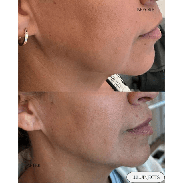 Jawline Filler before and after
