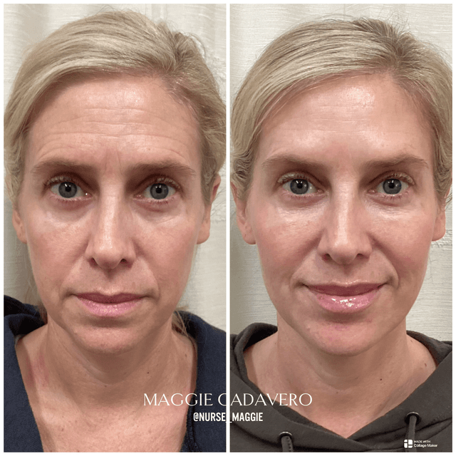 Lip Filler That Looks Like You, Just Plumped! The goal? Soft, hydrated lips with natural shape and definition. Think less “overdone,” more “you woke up like this.
