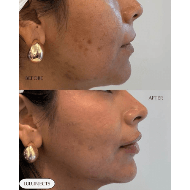 Full face chin and jawline filler before and after