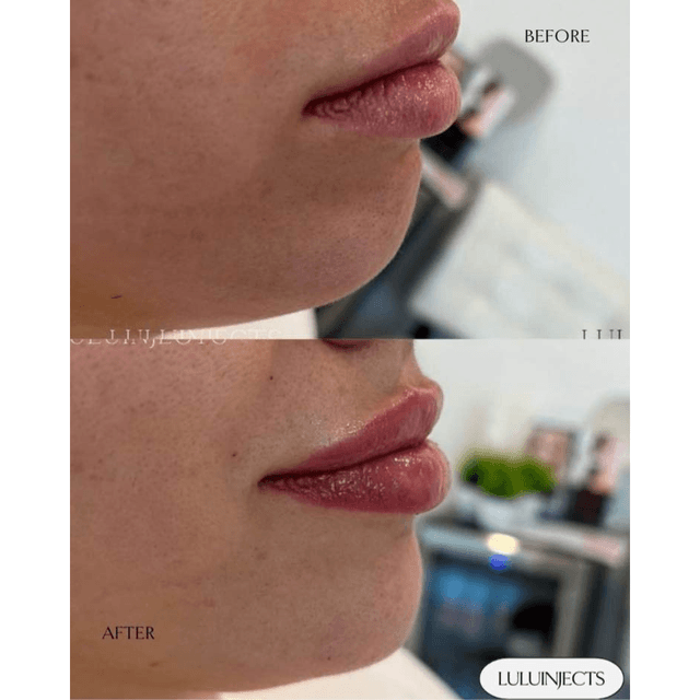 lip and chin filler combo