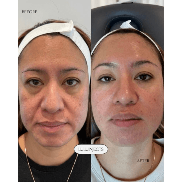 Medical grade skincare, skincare consultation, skin transformation, no filler results, Lulu Injects