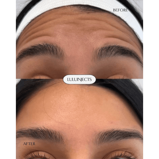 Forehead botox before and after